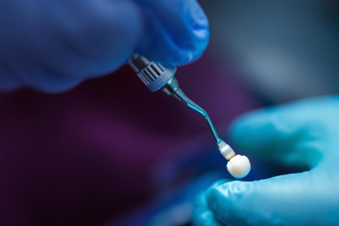 HBMD006 : reconstitution coronaire provisoire pour acte endodontique - remboursement et tarifs